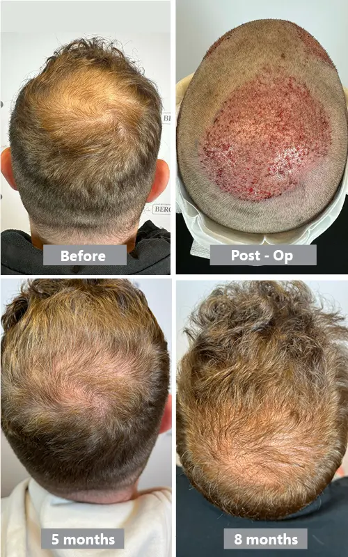 What to Consider Before a Crown Hair Transplant